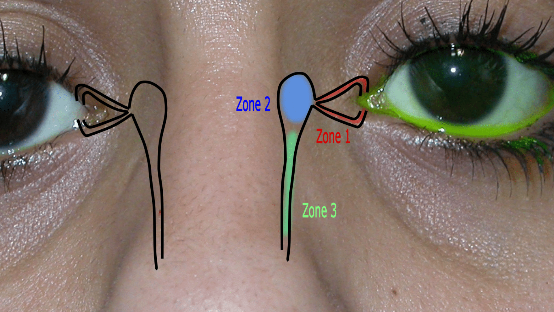 Identifying the various zones of the tear duct for watery eyes 