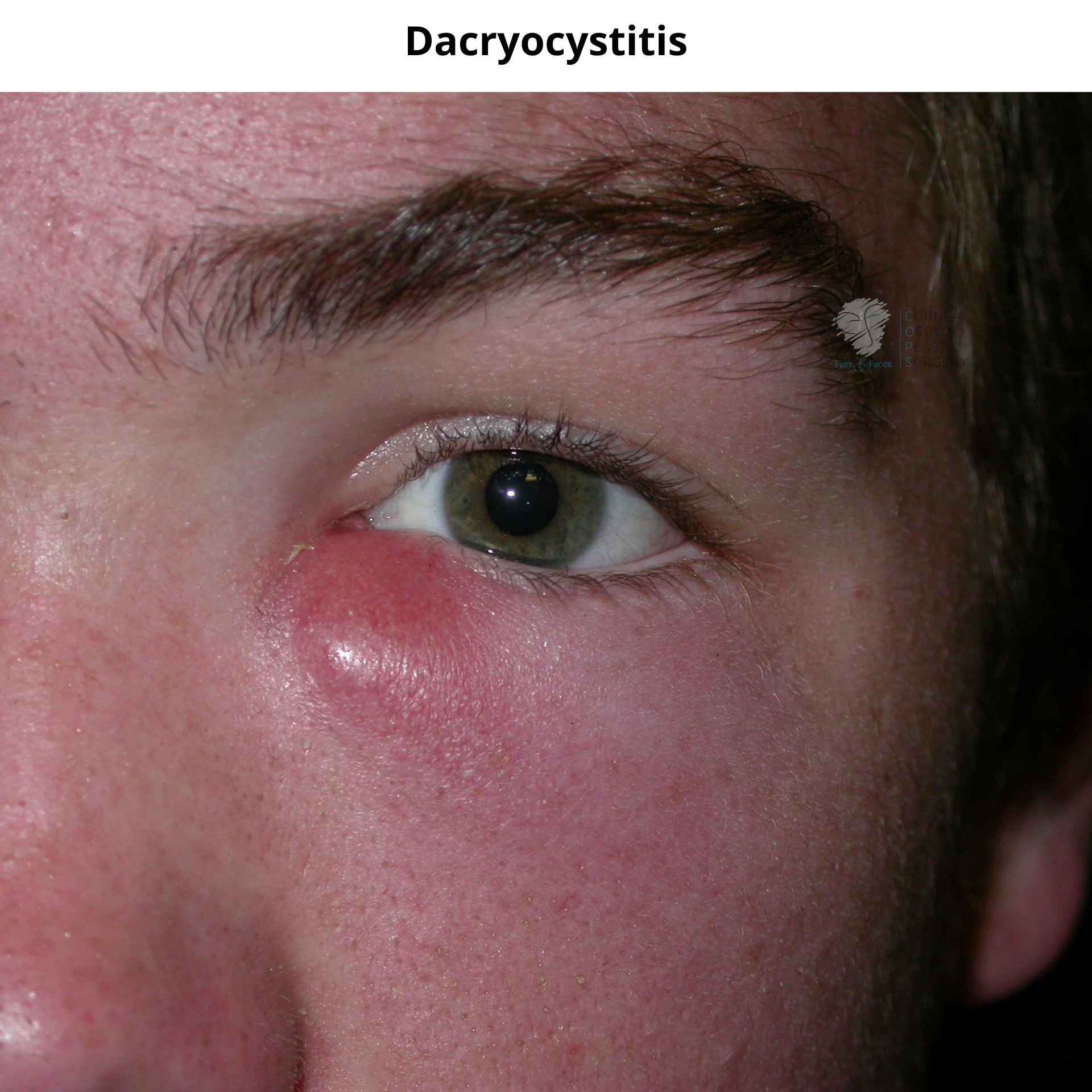 Dacryocystitis - notice the red and raised area under the eye. This is an infected sac. 